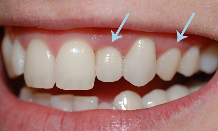 What is the best treatment for receding gums? | The best gum surgeon in Isfahan