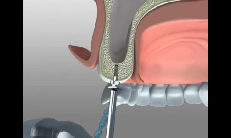What are the risks and complications of sinus lift? | The best gum surgeon in Isfahan