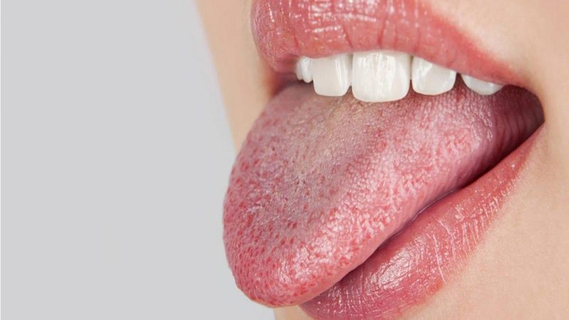 علت ، علائم و درمان برفک دهان چیست؟ | بهترین دندانپزشک زیبایی اصفهان
