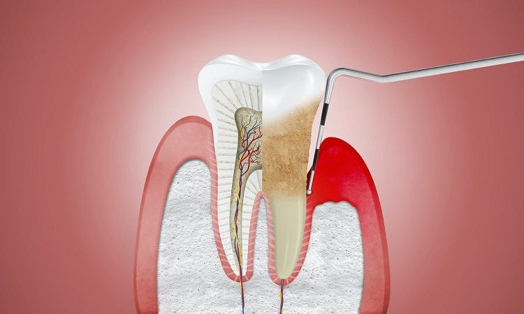 What are the causes and factors of gingivitis? | The best dentist in Isfahan