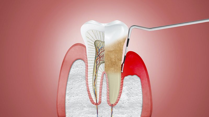 علل و عوامل بروز ورم لثه چیست؟ | بهترین دندانپزشک اصفهان