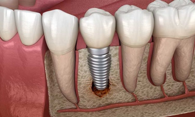 Facteurs courants du descellement des implants dentaires | Le meilleur implant à Ispahan
