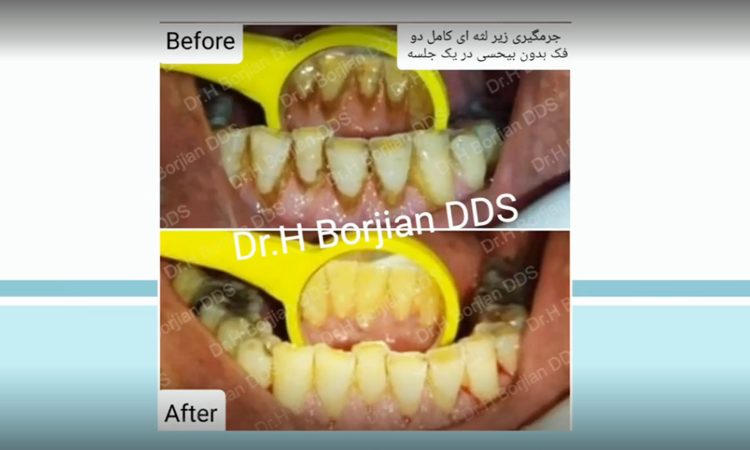 La première partie de l'exposé du Dr Hossein Borjian sur la nécessité du détartrage dentaire|Le meilleur dentiste d'Ispahan