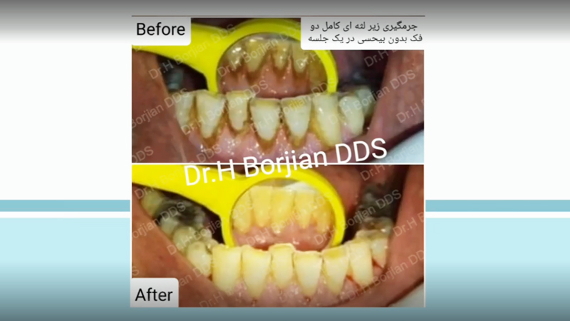 بخش اول صحبتهای دکتر حسین برجیان در مورد لزوم جرمگیری دندان|بهترین دندانپزشک اصفهان