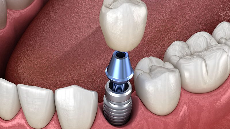 Cas pouvant être traités avec des implants dentaires sous-périostés | Le meilleur chirurgien des gencives à Ispahan