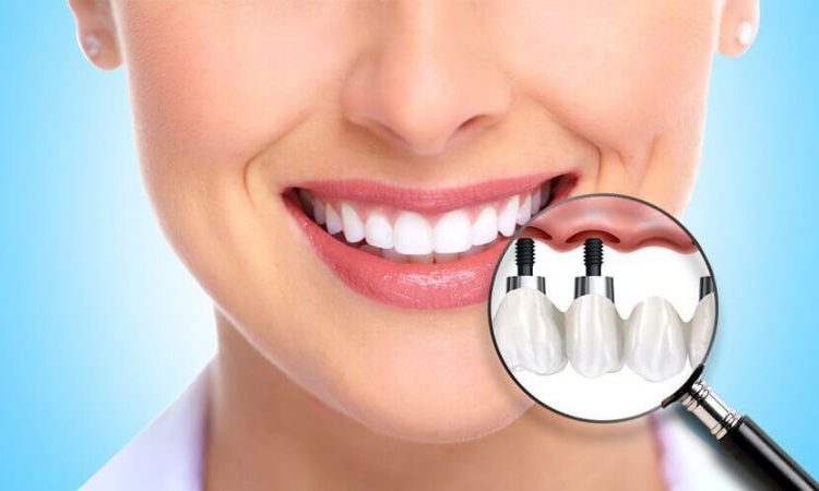 Cases that can be treated with subperiosteal dental implants | The best gum surgeon in Isfahan