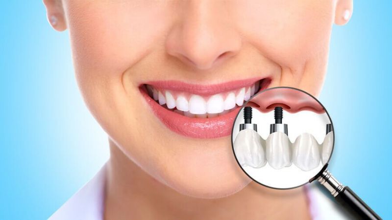 موارد قابل درمان با ایمپلنت‌های دندانی زیر پریوستال | أفضل جراح لثة في اصفهان