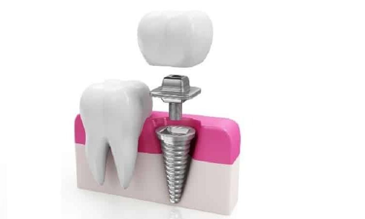 What are the contraindications for using mini implants? | The best gum surgeon in Isfahan