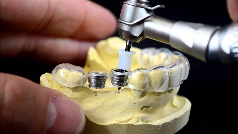 نکات مراقبتی از تک ایمپلنت‌ها و اُوردنچرها | Le meilleur dentiste d'Ispahan