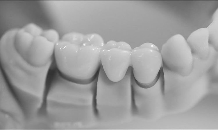 همه چیز راجع به روکش دندان عصب کشی شده | بهترین دندانپزشک اصفهان