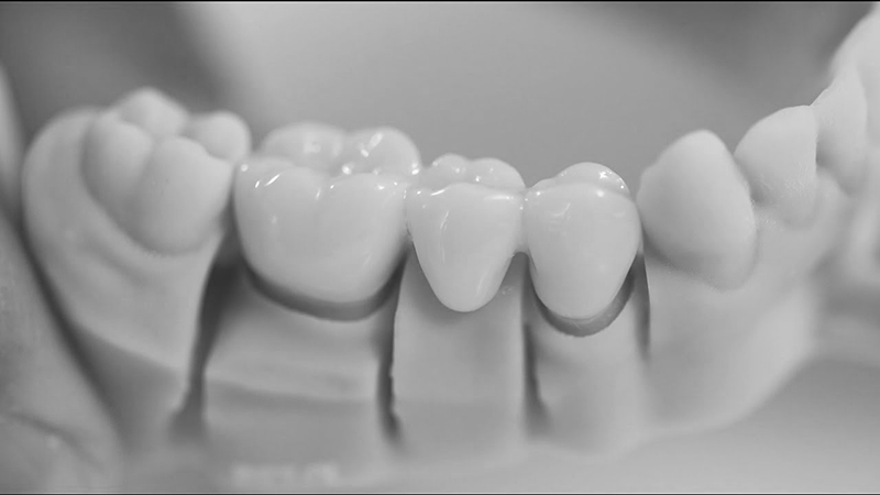 كل شيء عن قشرة الأسنان منزوعة الرطوبة | افضل دكتور اسنان في اصفهان