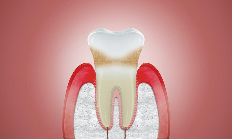 طرق تشخيص وعلاج التهاب اللثة | افضل دكتور اسنان في اصفهان
