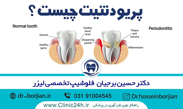 پریودنتیت چیست|بهترین دندانپزشک اصفهان