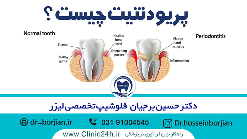 پریودنتیت چیست|بهترین دندانپزشک اصفهان