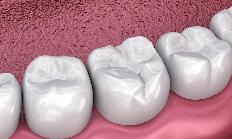 Ce que vous devez savoir sur le scellant dentaire pour fissures | Le meilleur dentiste d'Ispahan