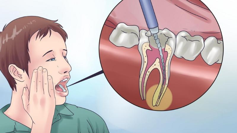 اقدامات مراقبتی پس از جراحی ریشه دندان | بهترین ایمپلنت اصفهان