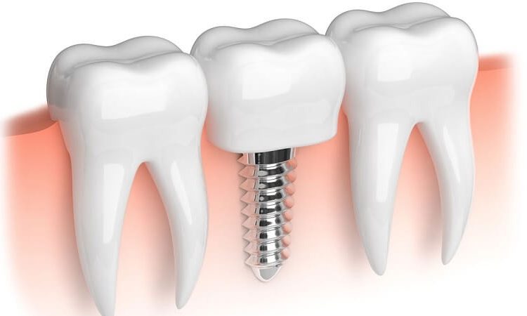 Investigating the causes of dental implant screw loosening | The best implant in Isfahan