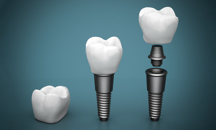 خيارات العلاج لاستبدال الأسنان المفقودة | افضل دكتور اسنان في اصفهان