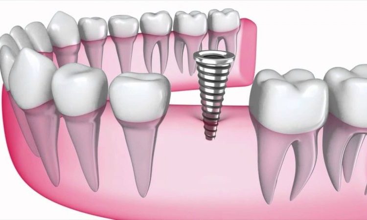 Methods to prevent dental implant screw loosening | The best implant in Isfahan