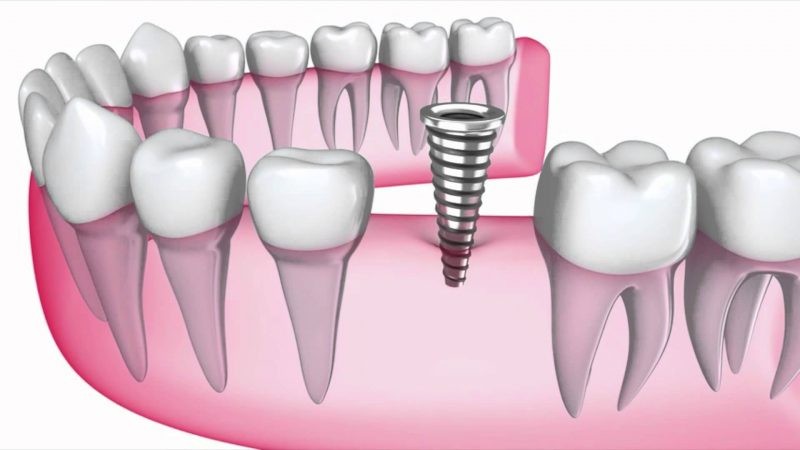 Methods to prevent dental implant screw loosening | The best implant in Isfahan