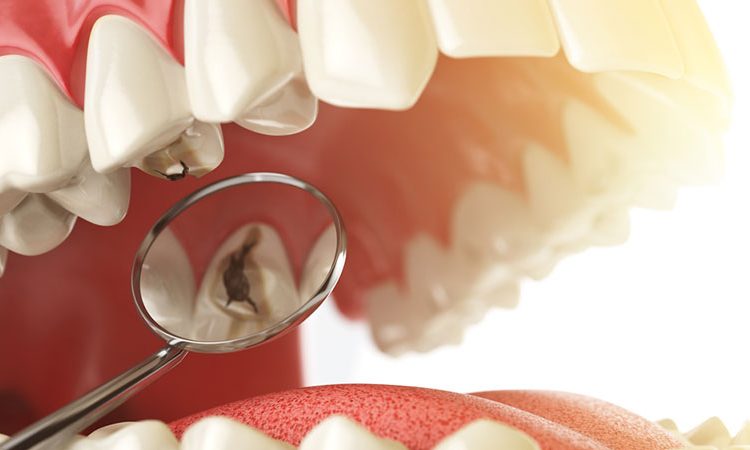 طرق منع تسوس الأسنان | افضل دكتور اسنان تجميلي في اصفهان