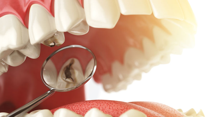 روش های پیشگیری از پوسیدگی دندان | بهترین دندانپزشک زیبایی اصفهان