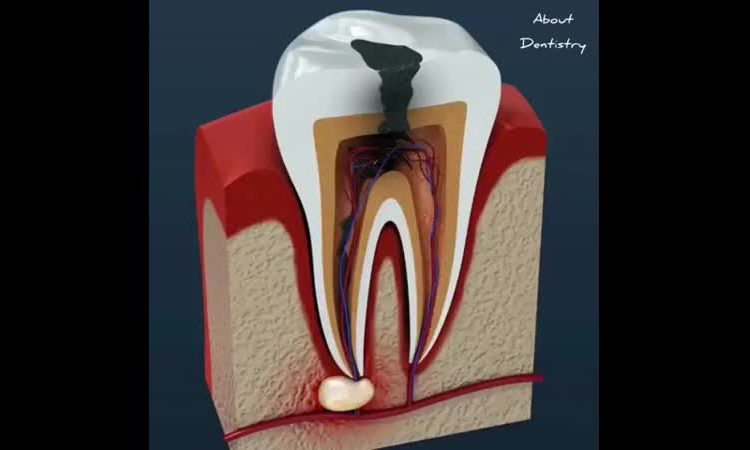 Symptoms and causes of dental abscess disease | The best gum surgeon in Isfahan