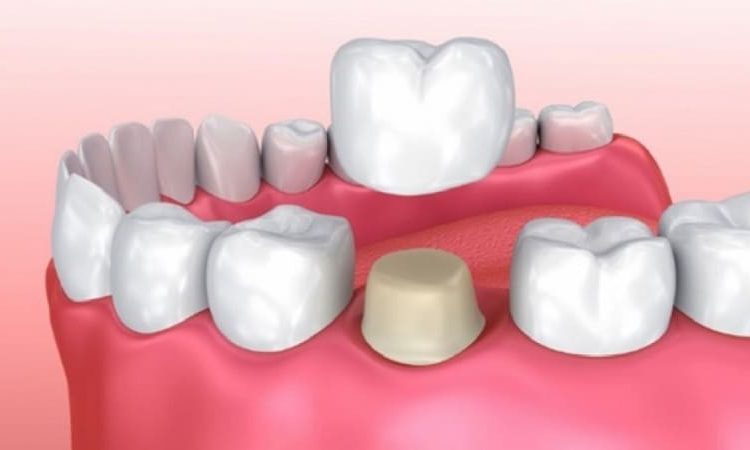 عوارض پس از نصب تاج دندان چیست؟ | Le meilleur dentiste d'Ispahan
