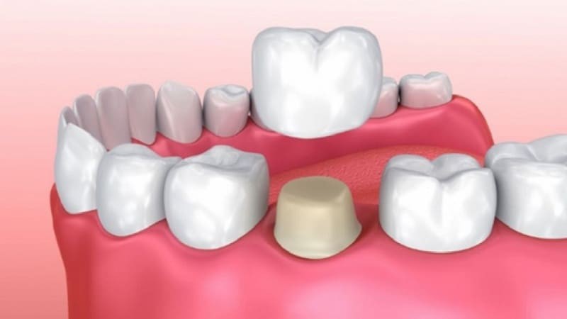 عوارض پس از نصب تاج دندان چیست؟ | بهترین دندانپزشک اصفهان