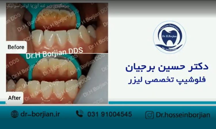 نمونه جرمگیری زیر لثه ای با اولتراسونیک (1)|بهترین دندانپزشک اصفهان