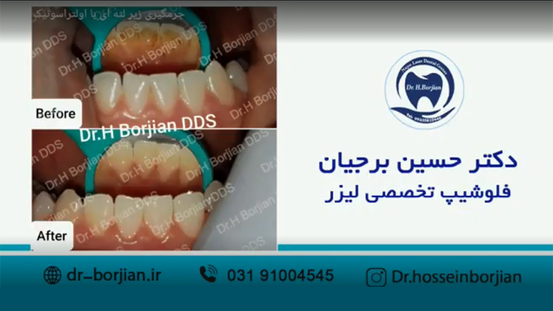 نمونه جرمگیری زیر لثه ای با اولتراسونیک (1)|بهترین دندانپزشک اصفهان
