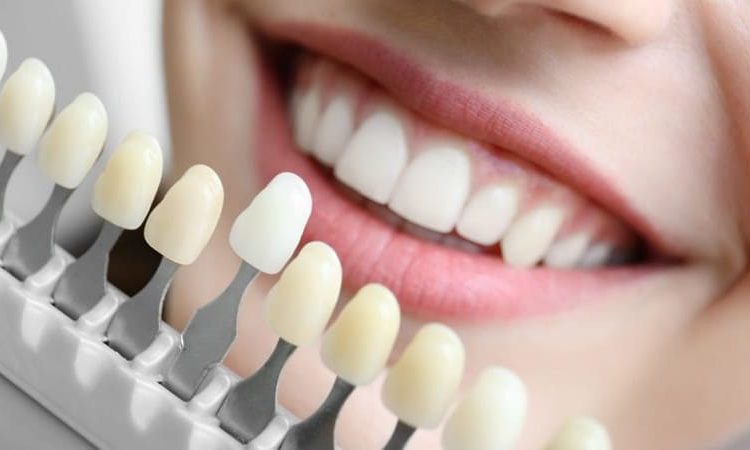 Correct care tips after dental lamination | The best dentist in Isfahan