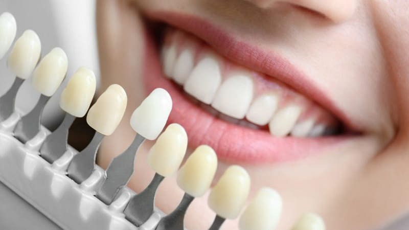 نکات مراقبتی صحیح بعد از لمینت دندان | بهترین دندانپزشک اصفهان