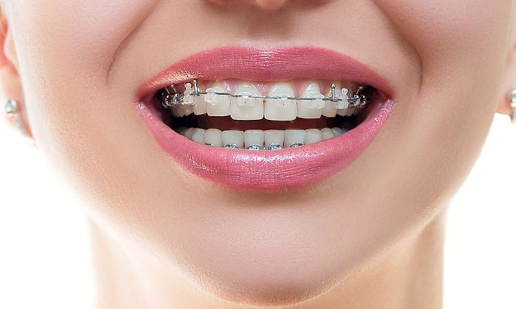 پاسخ به سوالات متداول در مورد درمان با ارتودنسی | بهترین دندانپزشک زیبایی اصفهان