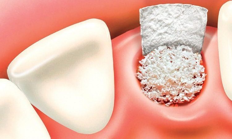 Applications of bone powder | The best implant in Isfahan