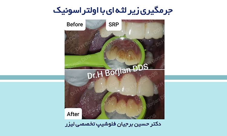 جرمگیری دندان|بهترین دندانپزشک اصفهان