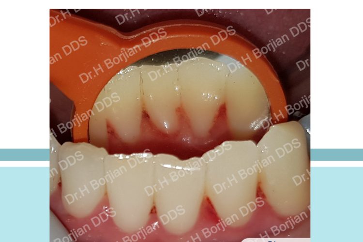 جرمگیری زیرلثه ای دندان|بهترین دندانپزشک اصفهان