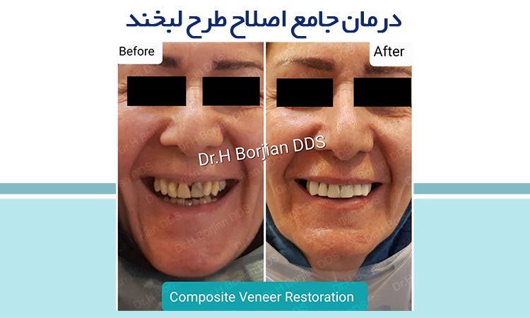 درمان جامع اصلاح طرح لبخند | بهترین دندانپزشک اصفهان