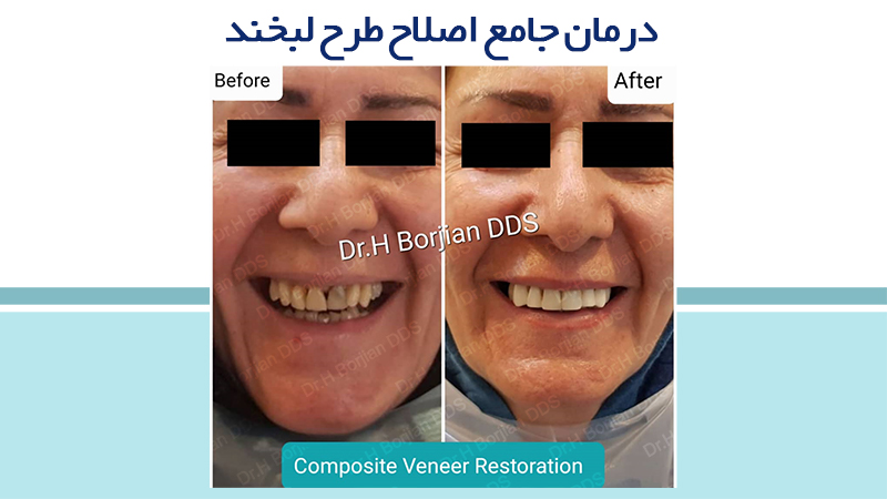 درمان جامع اصلاح طرح لبخند | بهترین دندانپزشک اصفهان