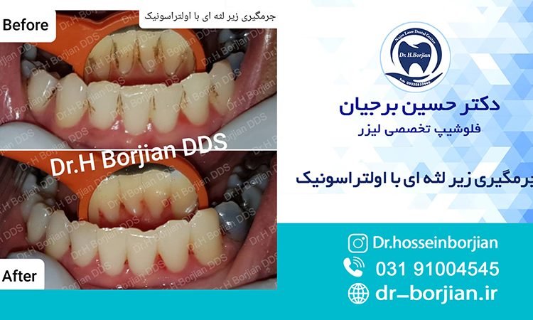 Subgingival scaling with ultrasound|The best dentist in Isfahan