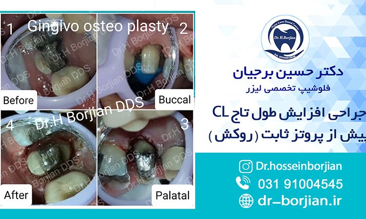 جراحی افزایش طول تاج CL پیش از پروتز ثابت|بهترین دندانپزشک اصفهان