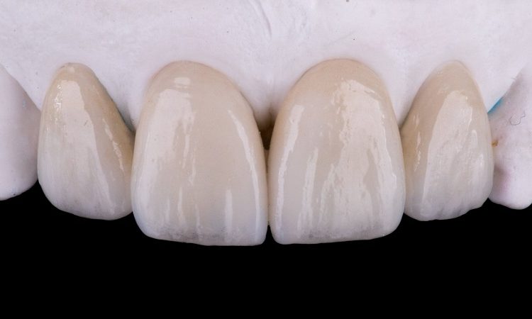 Familiarity with IPS ceramic laminate (EPS) | The best dentist in Isfahan