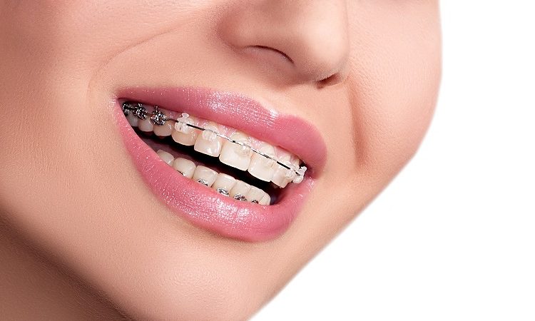 بررسی انواع ارتودنسی دندان نیش | بهترین دندانپزشک زیبایی اصفهان