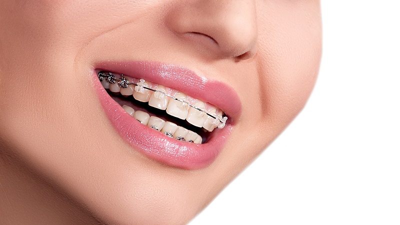بررسی انواع ارتودنسی دندان نیش | بهترین دندانپزشک زیبایی اصفهان
