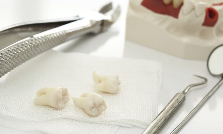 بررسی خطرات و عوارض کشیدن دندان | Le meilleur chirurgien des gencives à Ispahan