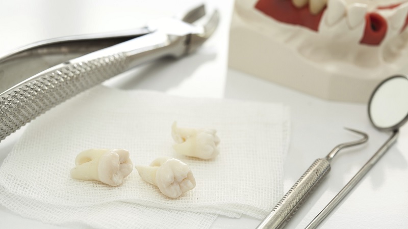 بررسی خطرات و عوارض کشیدن دندان | بهترین جراح لثه اصفهان