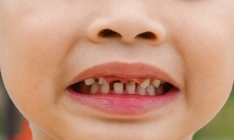 دلایل ایجاد فاصله بین دندان ها در کودکان | بهترین دندانپزشک اصفهان