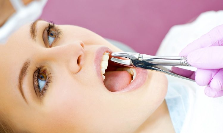 Raisons et comment faire une extraction dentaire | Le meilleur chirurgien des gencives à Ispahan