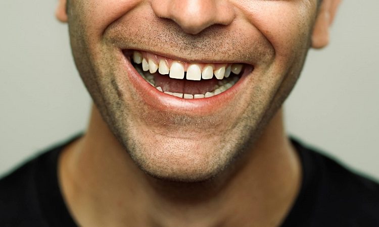 دیاستم یا فاصله های بین دندانی چیست؟ | بهترین دندانپزشک اصفهان