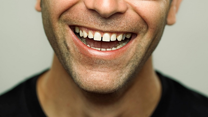 What is a diastema or spaces between teeth? | The best dentist in Isfahan